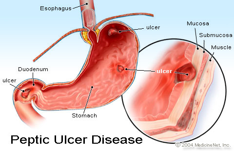 Diet Stomach Ulcer Sufferers